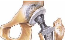 Hip Replacement
