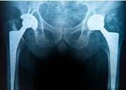 Hip Replacement Case Evaluation